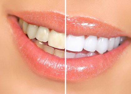 Teeth Whitening Before and After in Fredericksburg, VA.
